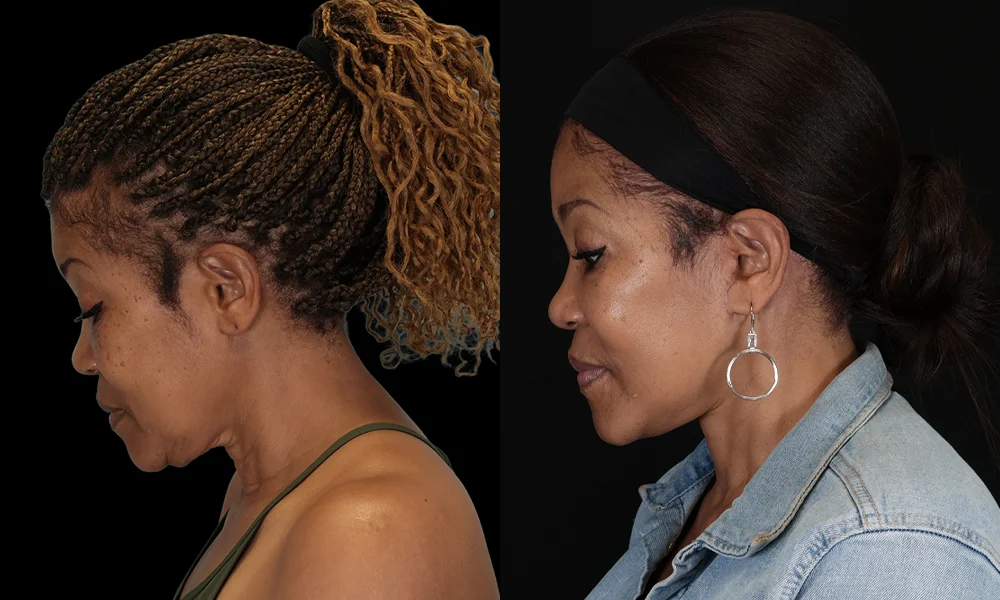 Real patient results in New York, NY Performed by Sameer Halani, MD