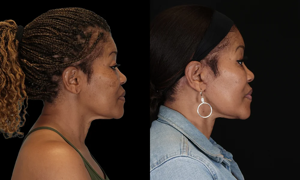 Real patient results in New York, NY Performed by Sameer Halani, MD