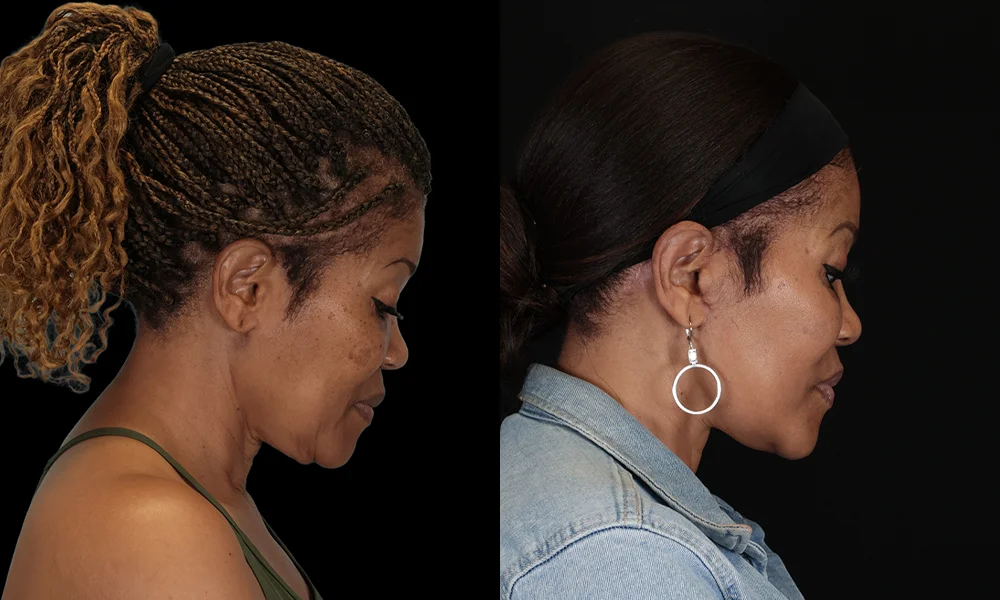 Real patient results in New York, NY Performed by Sameer Halani, MD