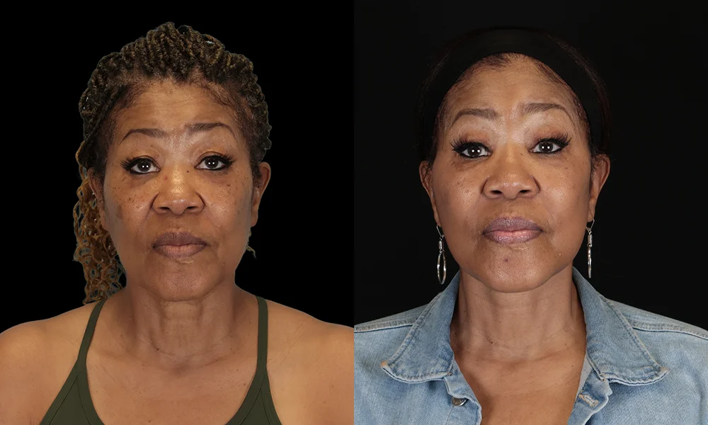 Real patient results in New York, NY Performed by Sameer Halani, MD