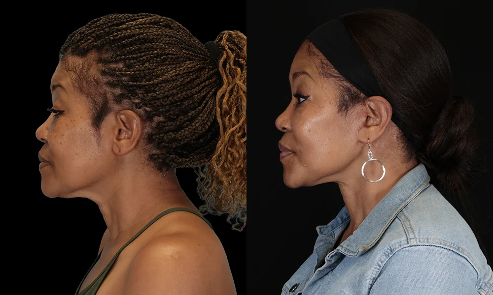 Real patient results in New York, NY Performed by Sameer Halani, MD