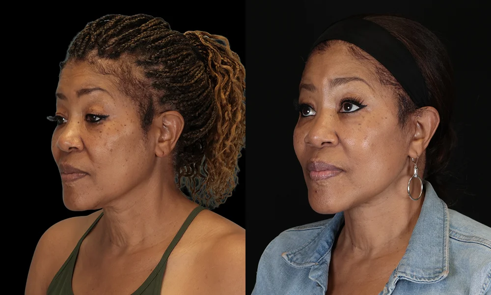 Real patient results in New York, NY Performed by Sameer Halani, MD