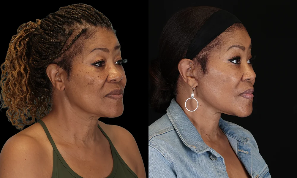 Real patient results in New York, NY Performed by Sameer Halani, MD