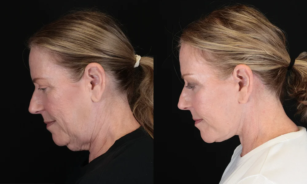 Real patient results in New York, NY Performed by Sameer Halani, MD