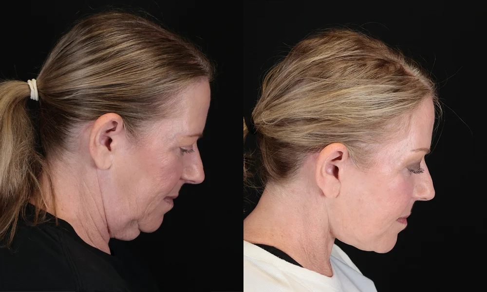 Real patient results in New York, NY Performed by Sameer Halani, MD