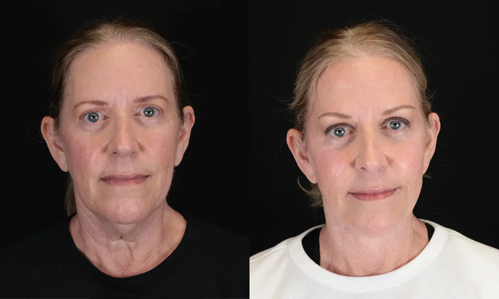 Real patient results in New York, NY Performed by Sameer Halani, MD
