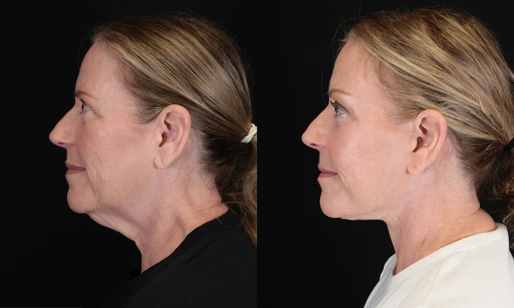 Real patient results in New York, NY Performed by Sameer Halani, MD
