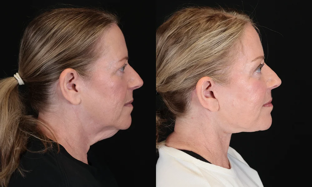 Real patient results in New York, NY Performed by Sameer Halani, MD
