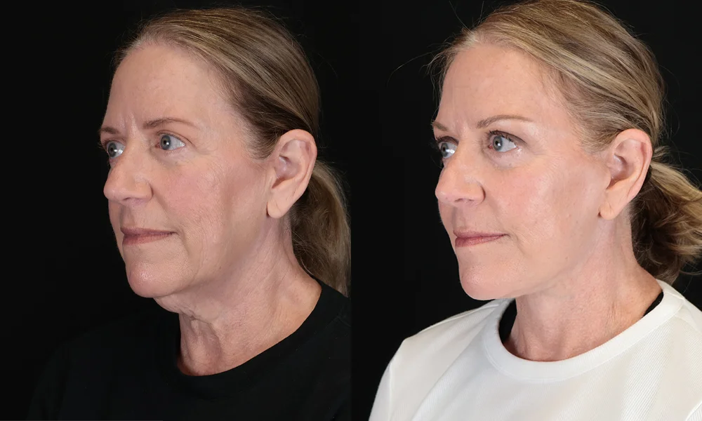 Real patient results in New York, NY Performed by Sameer Halani, MD