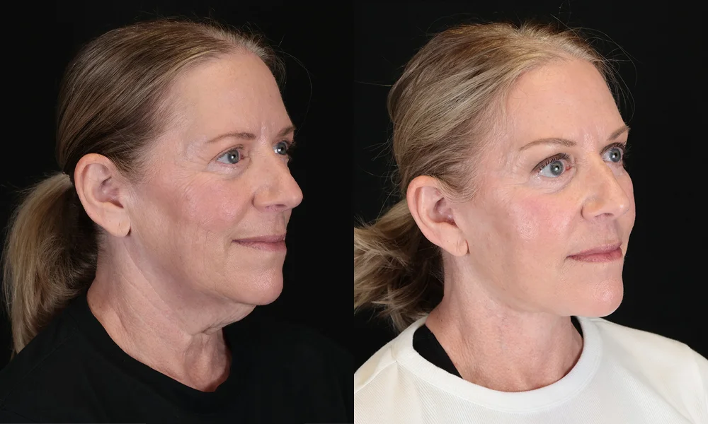 Real patient results in New York, NY Performed by Sameer Halani, MD
