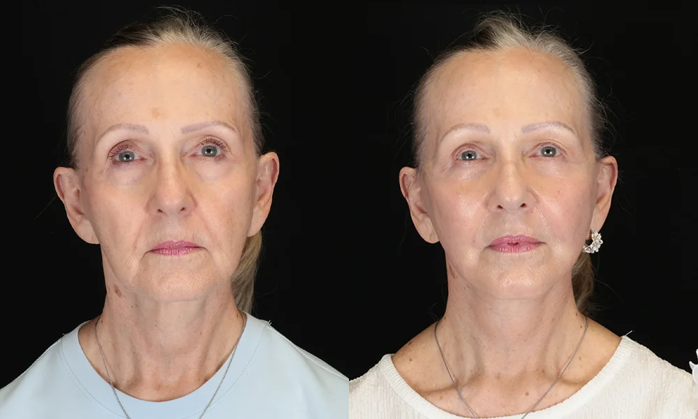 Real patient results in New York, NY Performed by Sameer Halani, MD