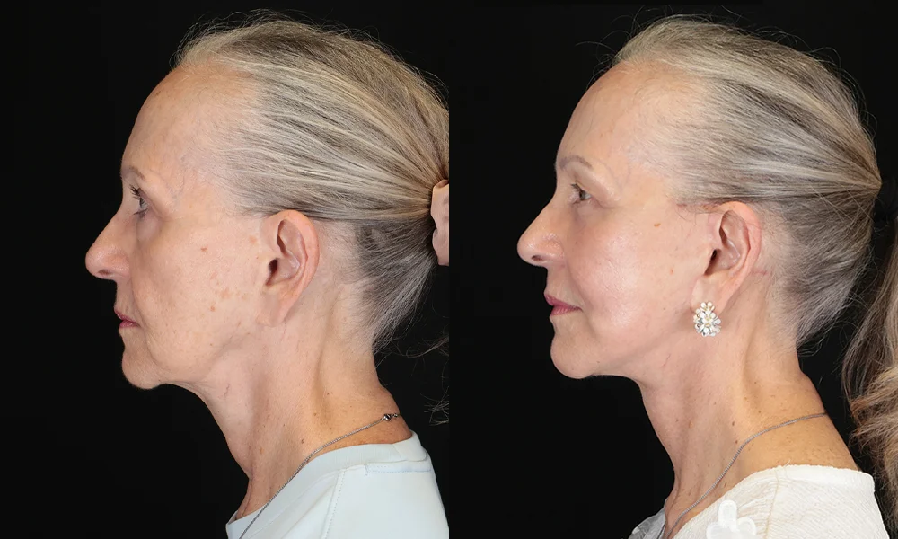 Real patient results in New York, NY Performed by Sameer Halani, MD