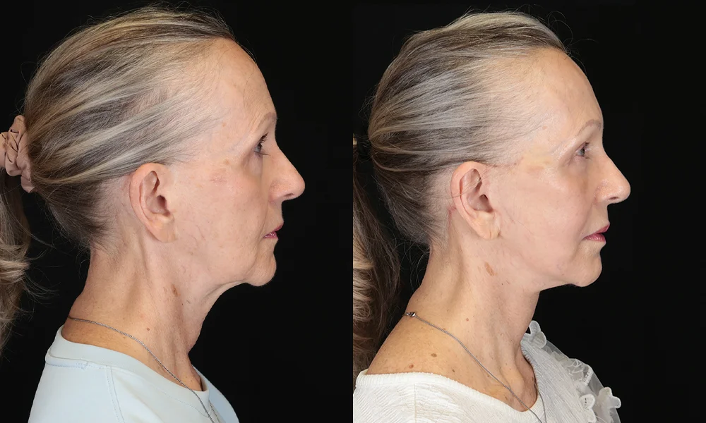 Real patient results in New York, NY Performed by Sameer Halani, MD