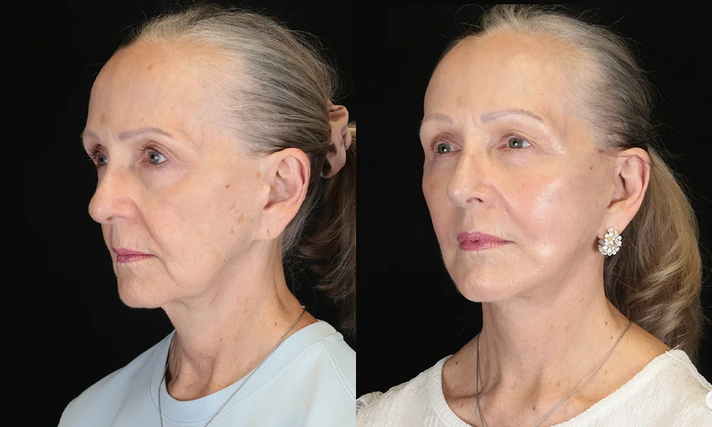 Real patient results in New York, NY Performed by Sameer Halani, MD
