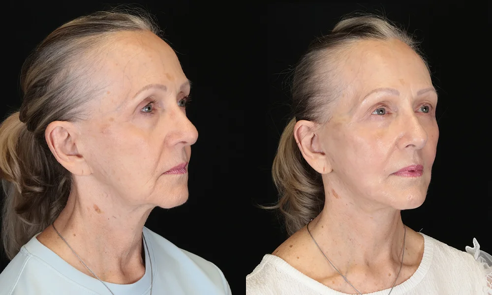 Real patient results in New York, NY Performed by Sameer Halani, MD
