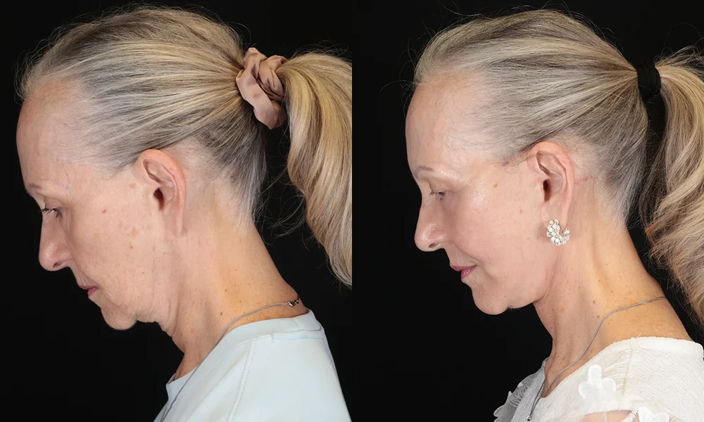 Real patient results in New York, NY Performed by Sameer Halani, MD
