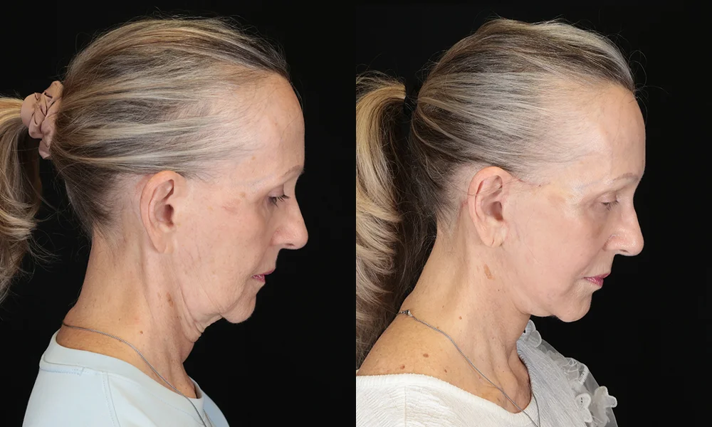 Real patient results in New York, NY Performed by Sameer Halani, MD