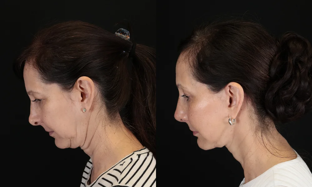 Real patient results in New York, NY Performed by Sameer Halani, MD