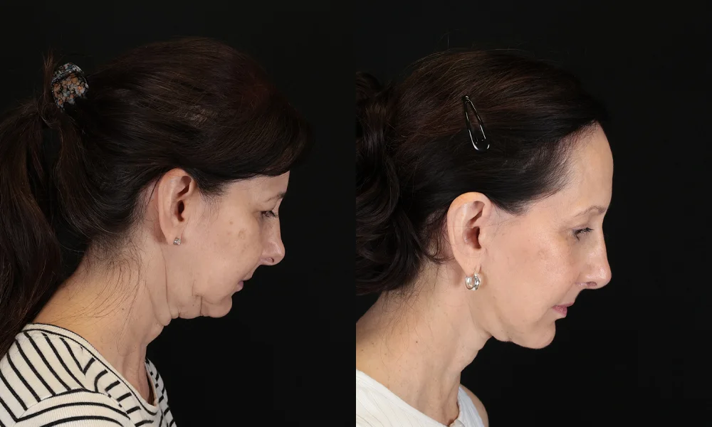 Real patient results in New York, NY Performed by Sameer Halani, MD