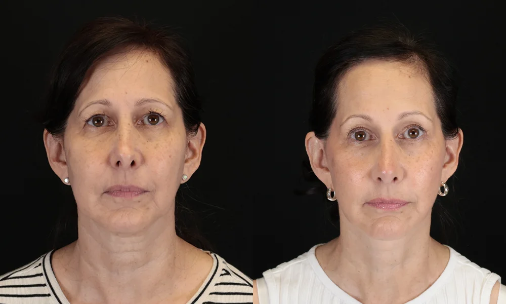 Real patient results in New York, NY Performed by Sameer Halani, MD
