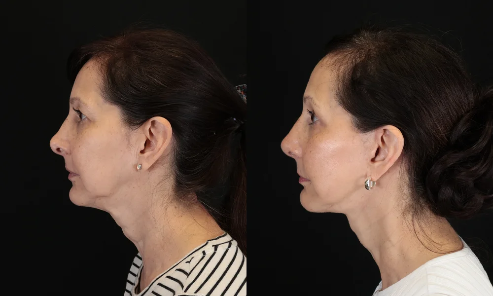 Real patient results in New York, NY Performed by Sameer Halani, MD