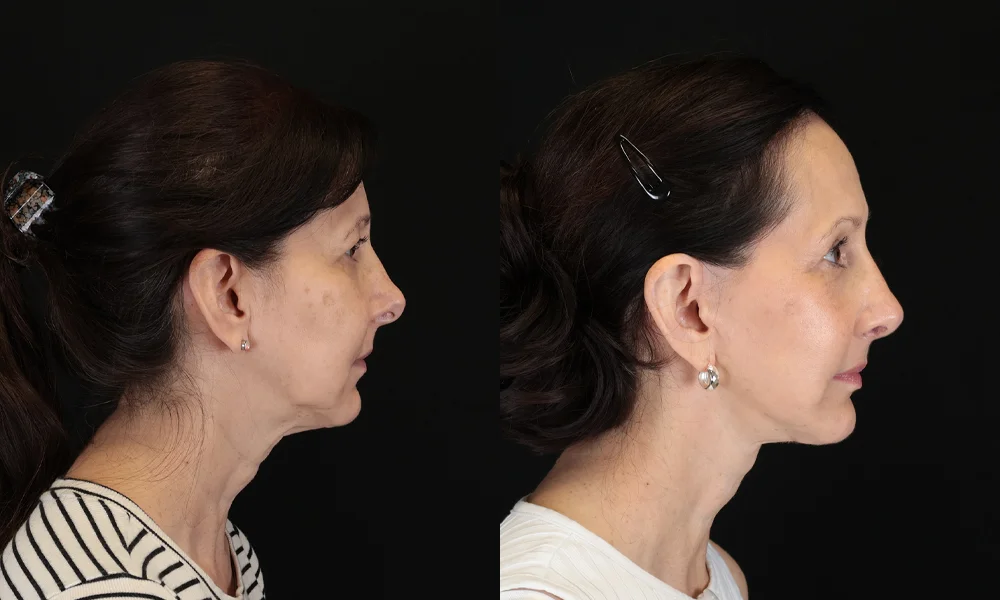Real patient results in New York, NY Performed by Sameer Halani, MD