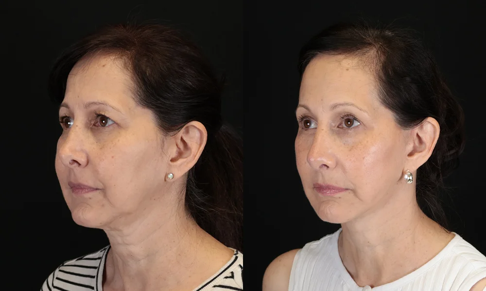 Real patient results in New York, NY Performed by Sameer Halani, MD