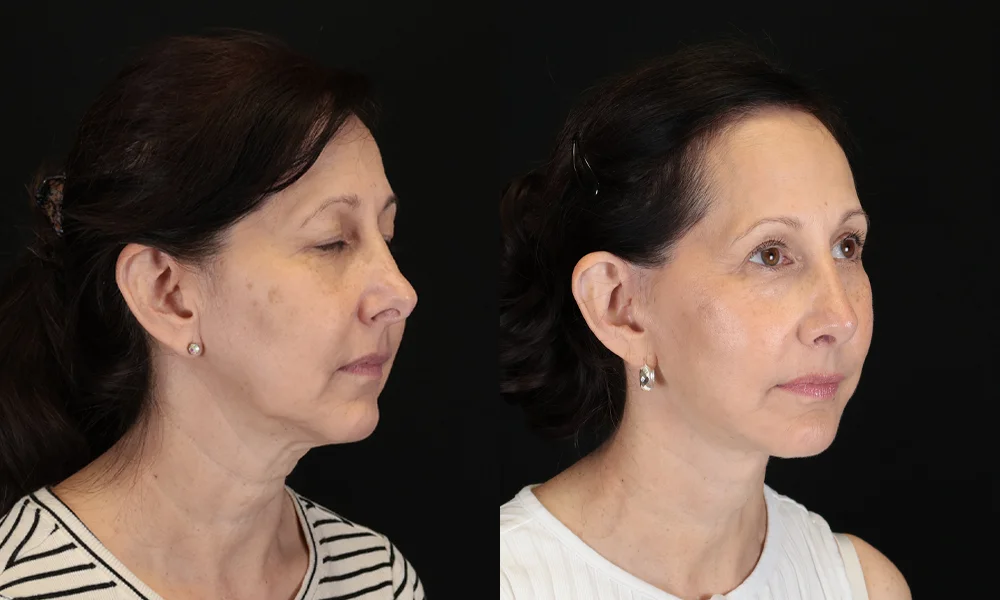 Real patient results in New York, NY Performed by Sameer Halani, MD