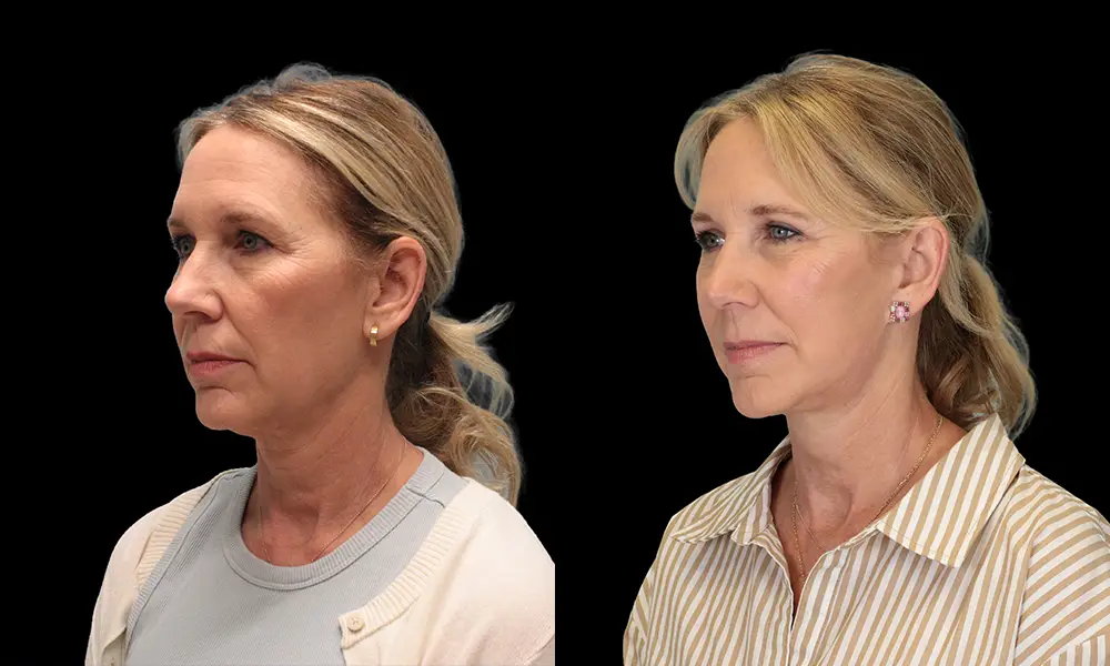 Real patient results in New York, NY Performed by Sameer Halani, MD
