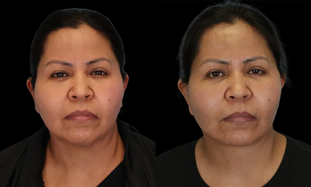 Real patient results in New York, NY Performed by Sameer Halani, MD