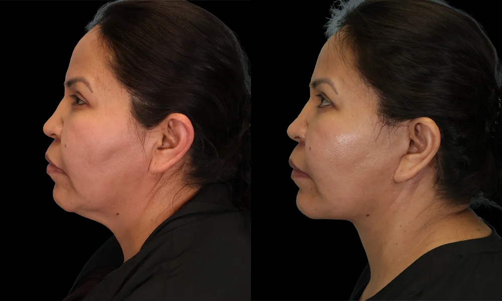 Real patient results in New York, NY Performed by Sameer Halani, MD