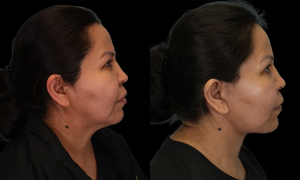 Real patient results in New York, NY Performed by Sameer Halani, MD