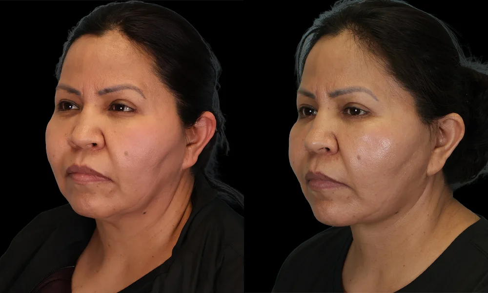 Real patient results in New York, NY Performed by Sameer Halani, MD