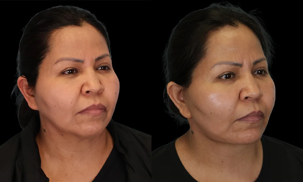 Real patient results in New York, NY Performed by Sameer Halani, MD