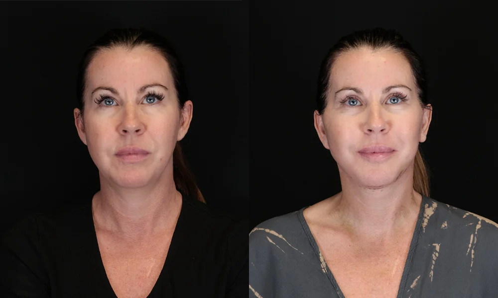 Real patient results in New York, NY Performed by Sameer Halani, MD