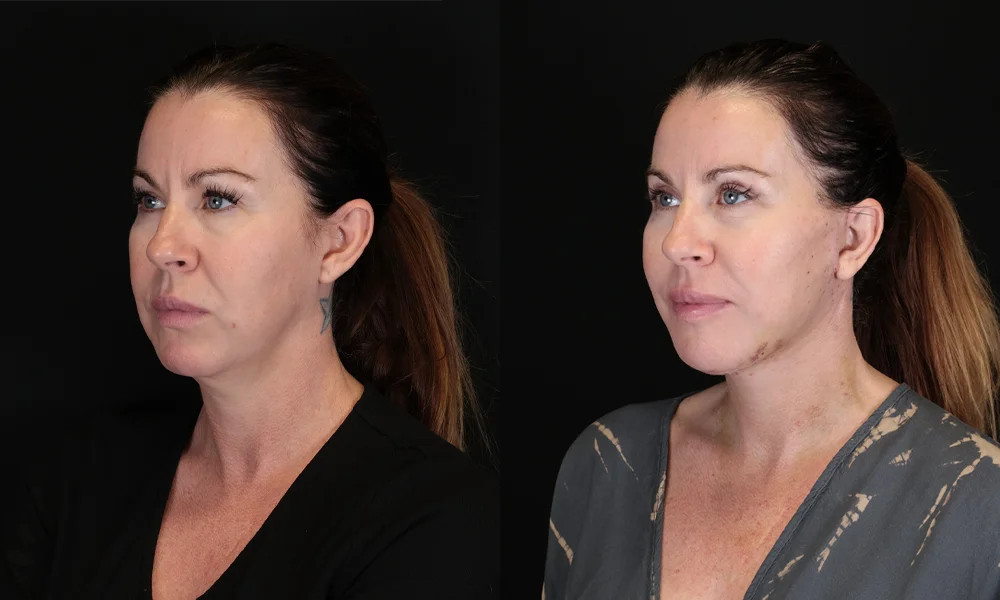 Real patient results in New York, NY Performed by Sameer Halani, MD