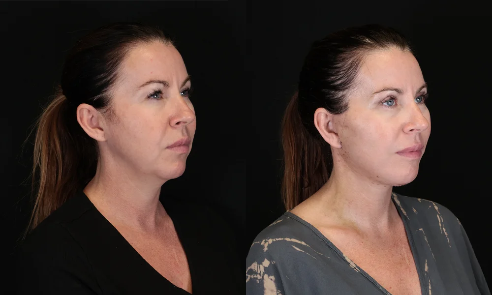 Real patient results in New York, NY Performed by Sameer Halani, MD
