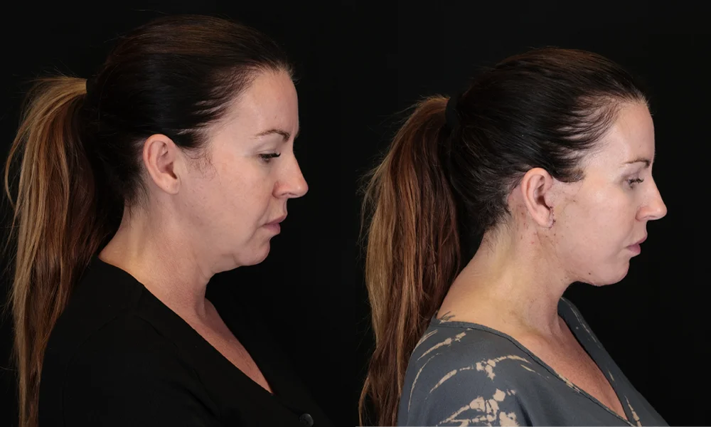 Real patient results in New York, NY Performed by Sameer Halani, MD