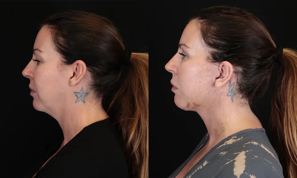 Real patient results in New York, NY Performed by Sameer Halani, MD