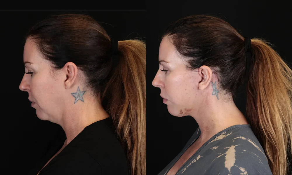 Real patient results in New York, NY Performed by Sameer Halani, MD