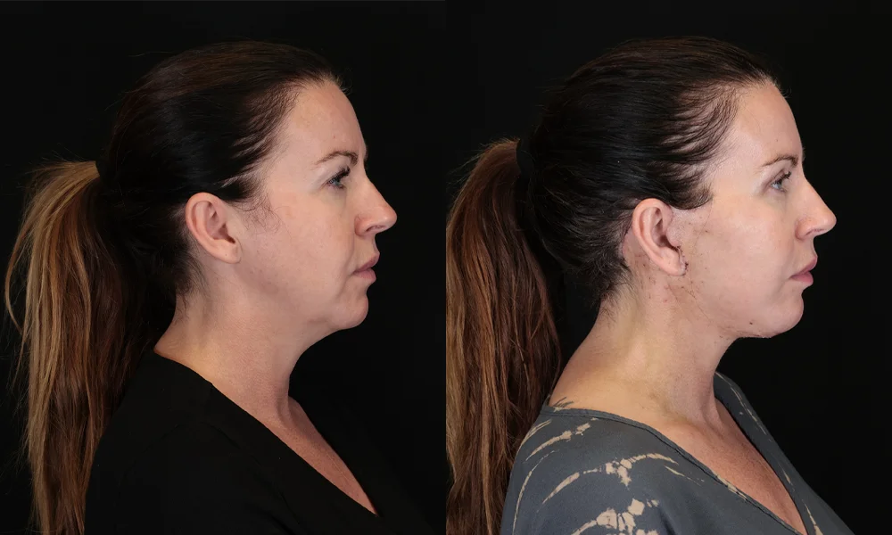Real patient results in New York, NY Performed by Sameer Halani, MD