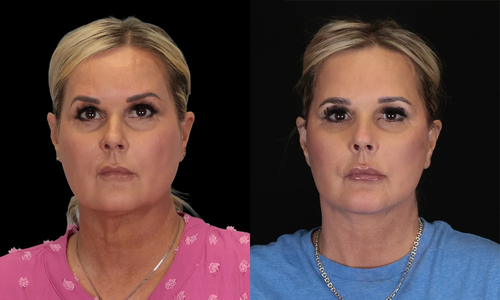 Real patient results in New York, NY Performed by Sameer Halani, MD