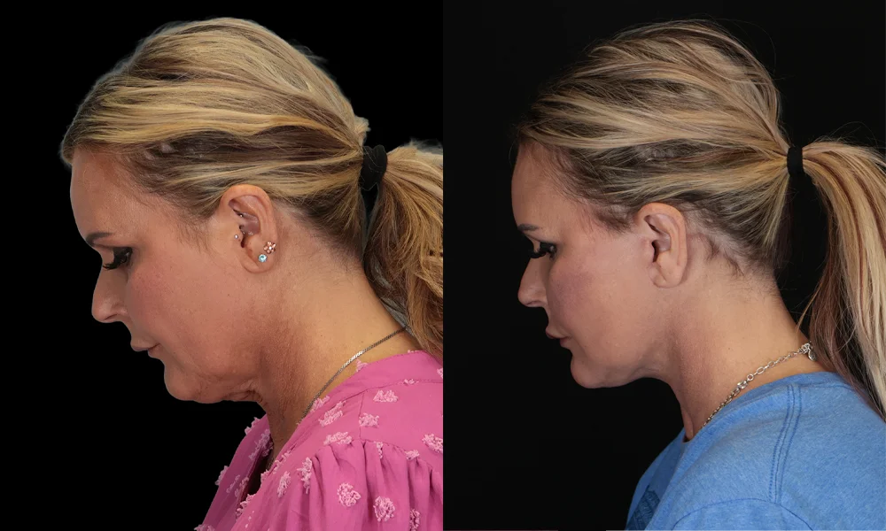 Real patient results in New York, NY Performed by Sameer Halani, MD