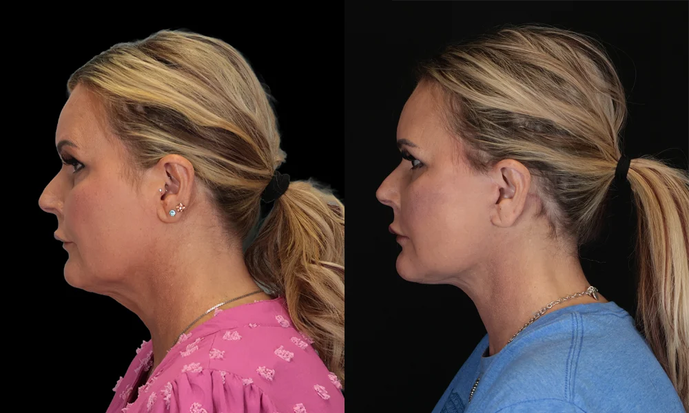 Real patient results in New York, NY Performed by Sameer Halani, MD