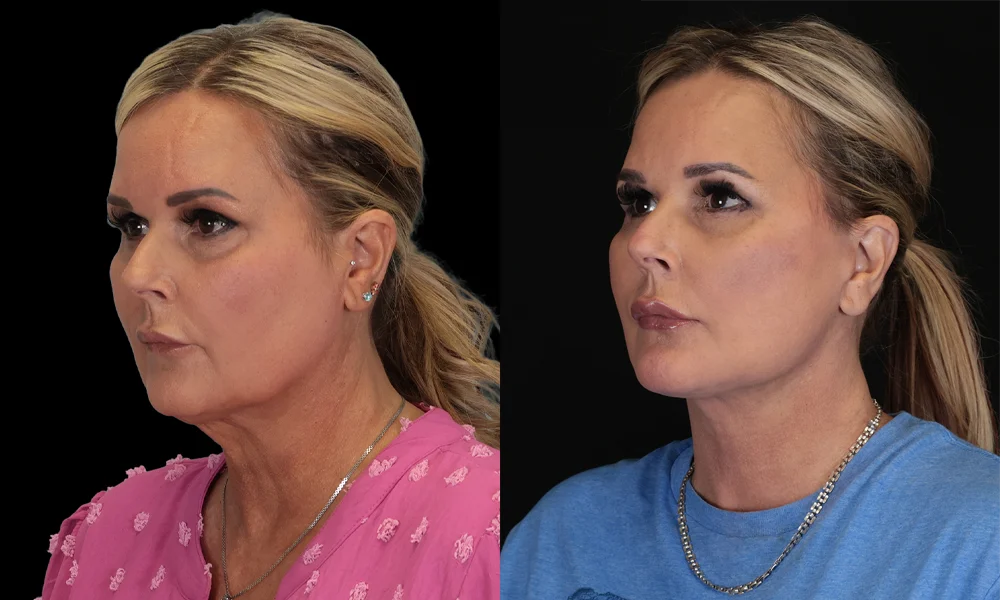 Real patient results in New York, NY Performed by Sameer Halani, MD