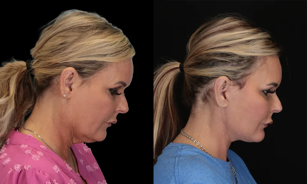Real patient results in New York, NY Performed by Sameer Halani, MD