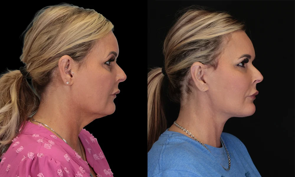 Real patient results in New York, NY Performed by Sameer Halani, MD