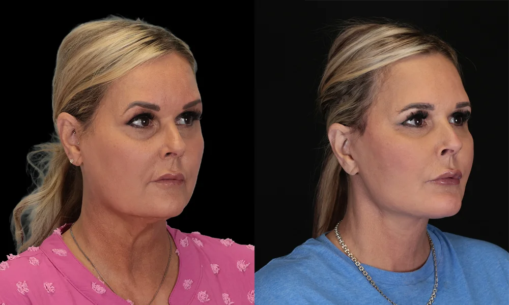 Real patient results in New York, NY Performed by Sameer Halani, MD