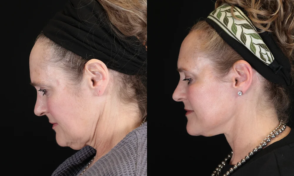 Real patient results in New York, NY Performed by Sameer Halani, MD