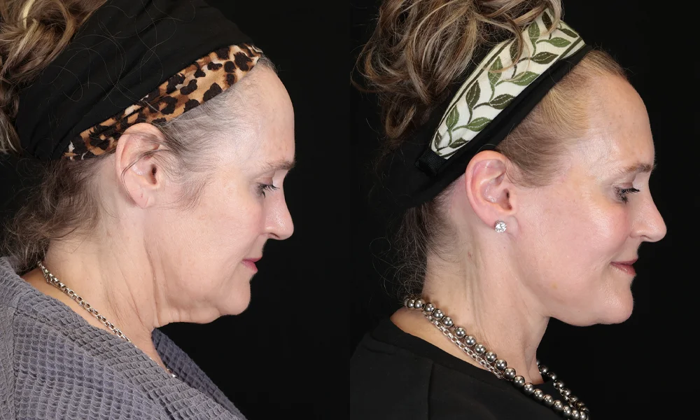 Real patient results in New York, NY Performed by Sameer Halani, MD